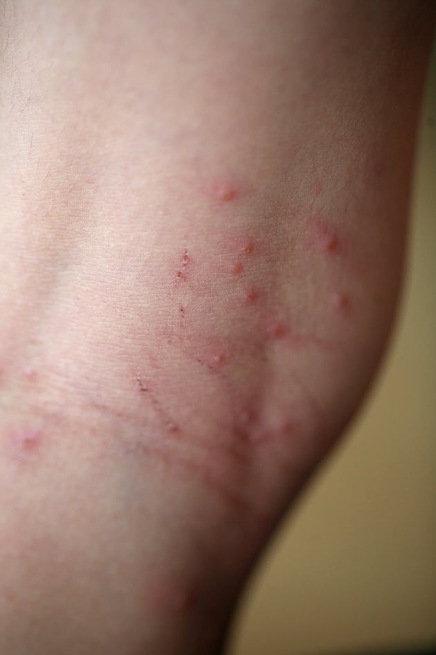 What are some non-toxic methods for removing chiggers?
