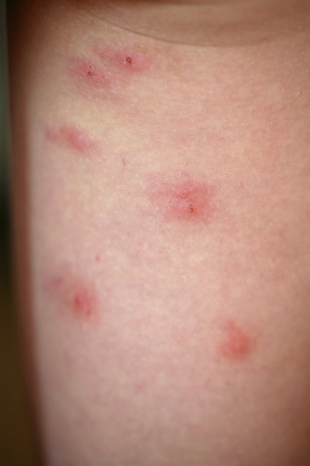 Chigger bites on the back of the leg. 